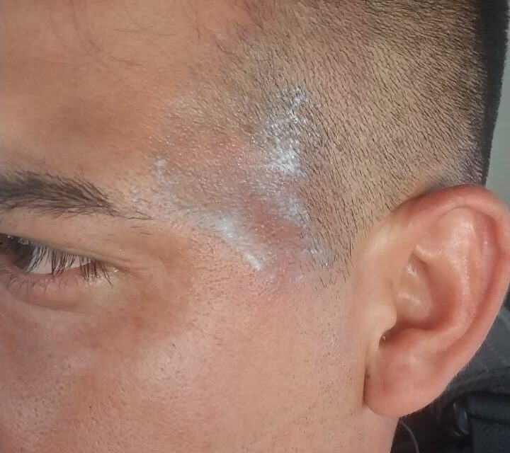 Quemaron con agua hirviendo a un policía en un operativo